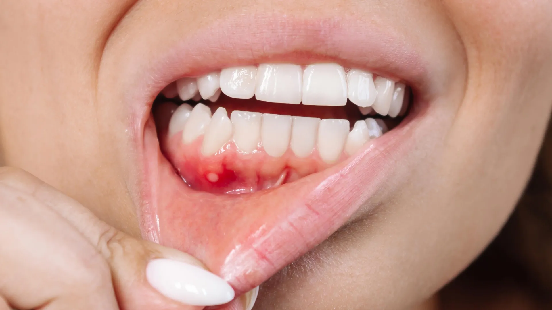 Um composto vegetal pode ser a arma secreta contra a doença gengival.