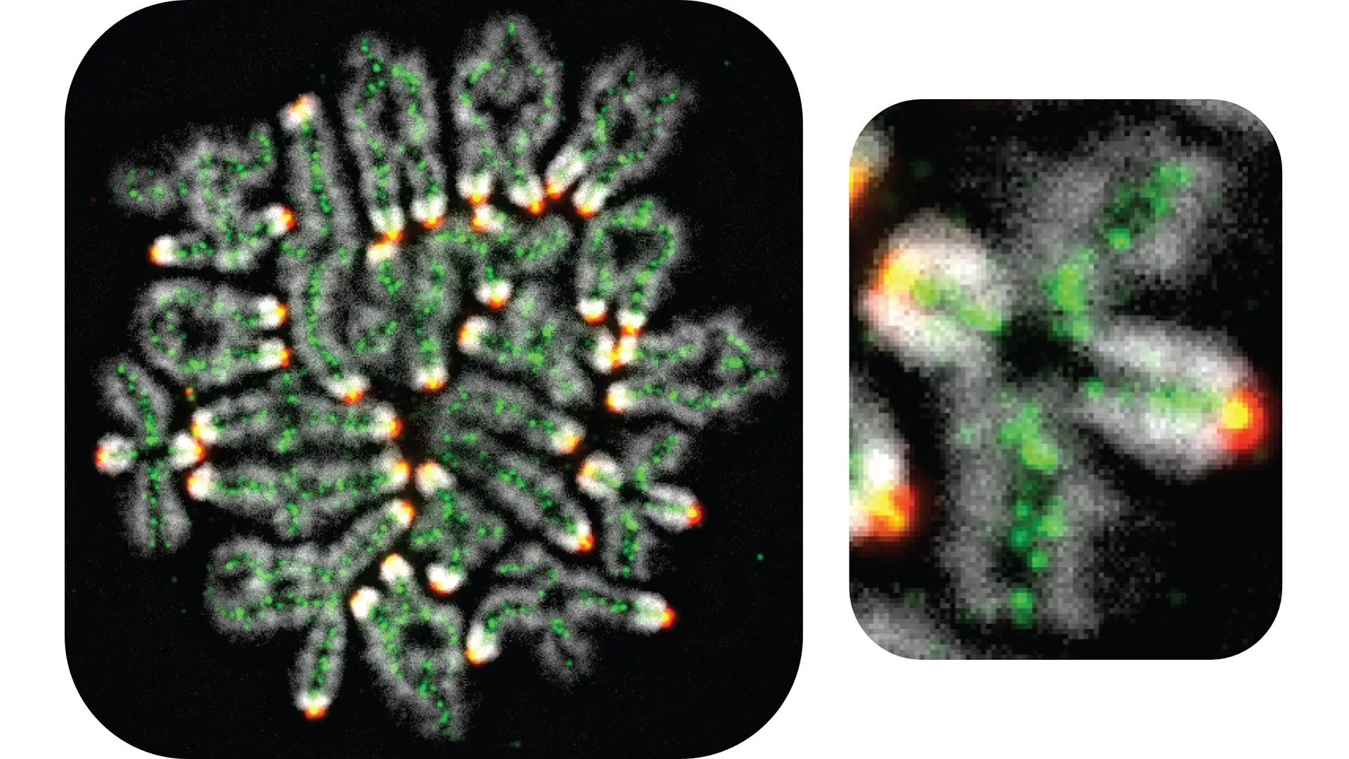 Abortos, Síndrome de Down e Infertilidade: Todos relacionados a este processo genético oculto.