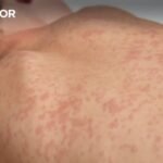 <p>Portugal contabilizou 20 ocorrências de sarampo desde o começo do ano</p>